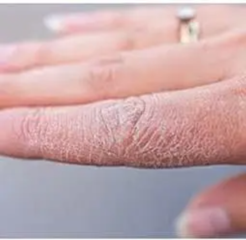 dermatite atopica tratamento natural